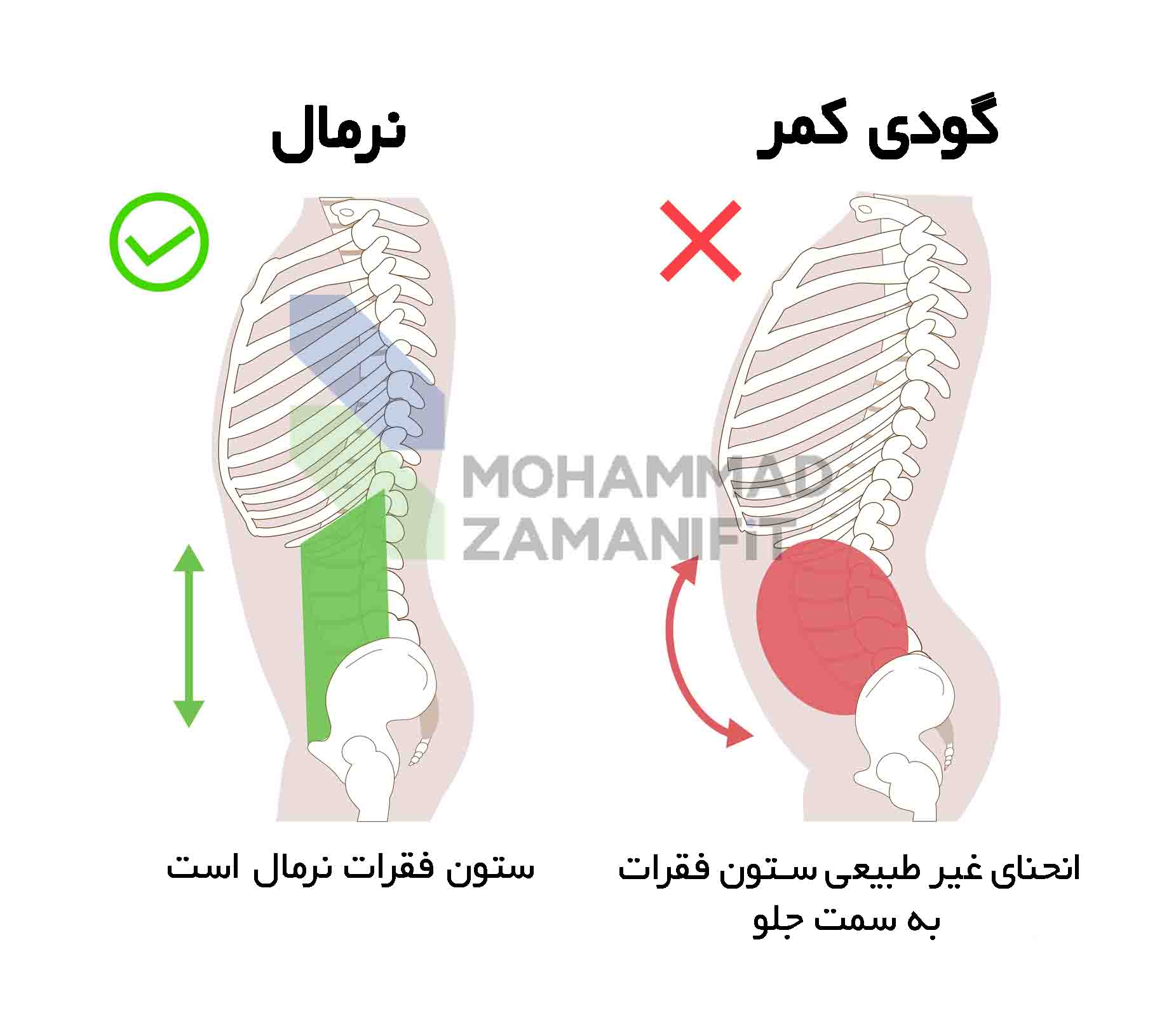گودی کمر یا لوردوز عارضهای است که انحنای طبیعی کمر بیش از حد معمول باشد و با مشکلاتی مثل درد و ضعف عضلانی همراه است که در این مقاله درمان گودی کمر را آموزش دادهام.
