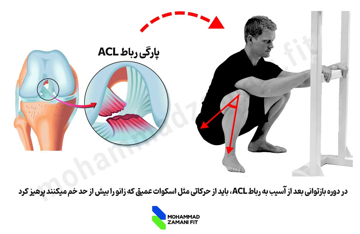 در پارگی ACL نباید حرکاتی انجام داد که زانو بیش از حد خم میشود